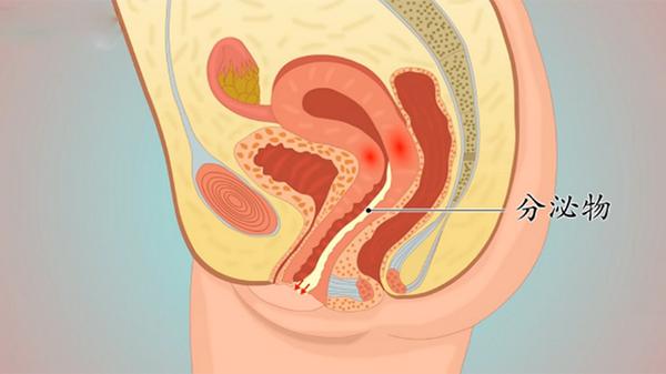 慢性宫颈炎有什么影响 导致慢性宫颈炎的原因