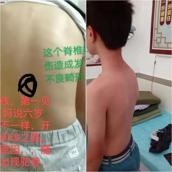驼背最快的恢复方法_青少年驼背最快的恢复方法