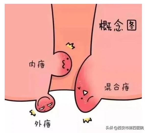 痔疮长在哪里（痔疮长在哪里女图片）