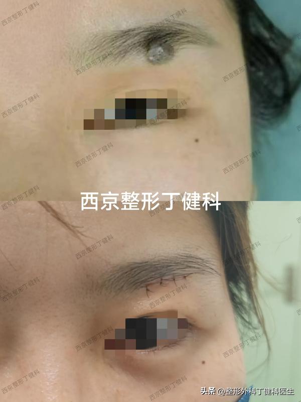 眉毛长痣图解大全_男人脸上痣图解大全