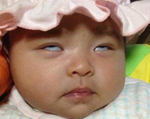兒童失神性癲癇