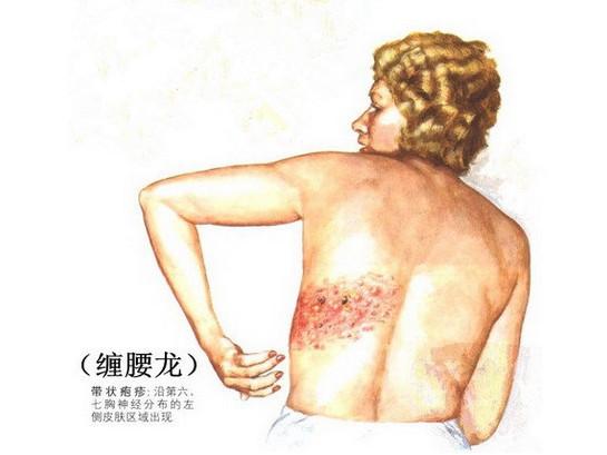 “缠腰龙”缠腰一圈会死人，这不是真的！