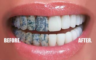 谁在“抹黑”我们的牙齿？美白牙膏有用吗