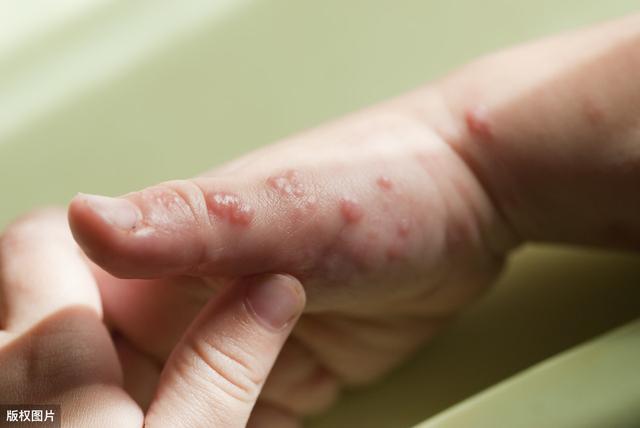 湿疹、皮炎、荨麻疹，皮肤科常见病的诊断及联合用药方案汇总大全