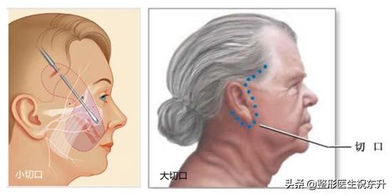 小切口提升和拉皮手术的区别是什么？