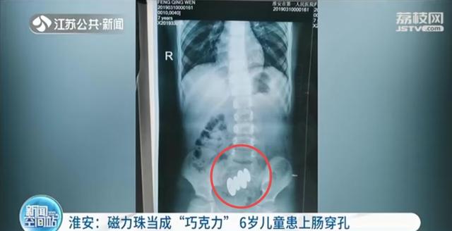 磁力珠当成“巧克力”！6岁男孩吞下四颗珠子导致肠穿孔