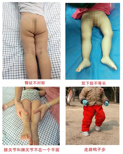 始料未及!一家俩先髋儿,不可侥幸避筛查,髋关节发育不良需早治