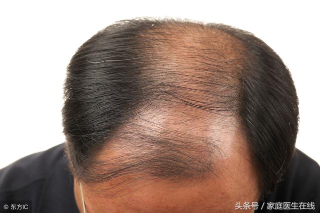 男人秃顶的5个原因，你知道几个？早点了解还能预防