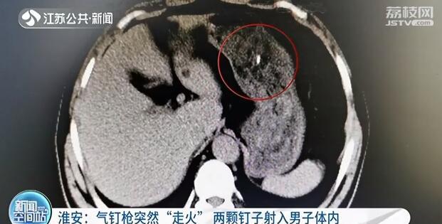 气钉枪突然“走火”两颗钉子射入男子体内