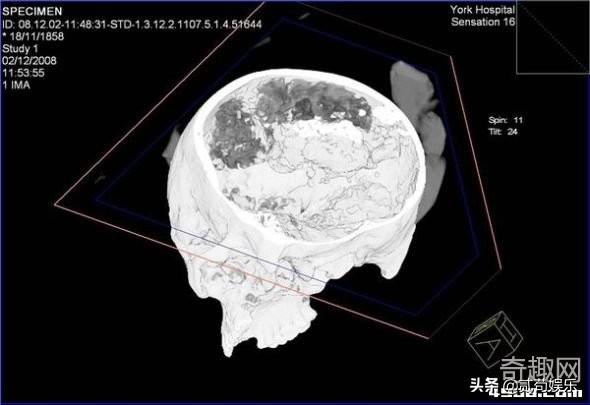 考古学家发现一颗已有2500年历史的头骨，保存有完好的大脑组织