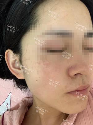 唯诺雅细数那些让人显老十岁的斑，你该怎么对付？