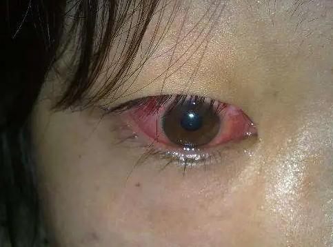 眼睛红血丝是不是红眼病?