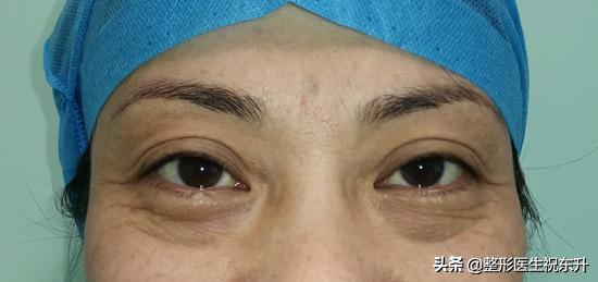 40多岁有严重的眼袋，大家有什么好方法推荐吗?割眼袋能维持多久?