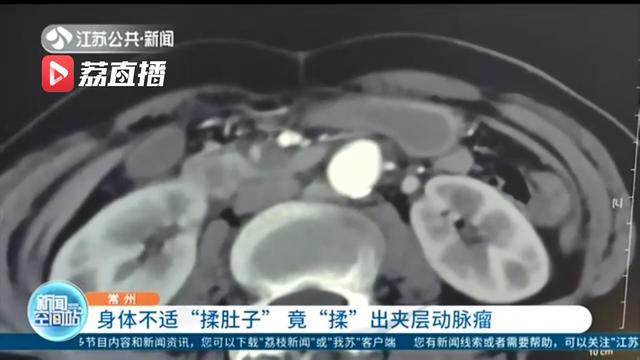 危险！不慎将一根血管壁揉破 女子身体不适揉肚子揉出夹层动脉瘤