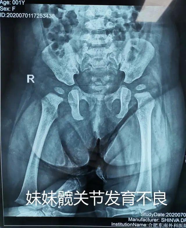 始料未及!一家俩先髋儿,不可侥幸避筛查,髋关节发育不良需早治