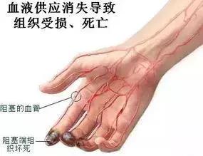 血栓闭塞性脉管炎中医病名