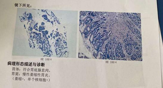 两腿酸软无力有点痛，查出了胃部恶性变，给四十岁以上的人提个醒