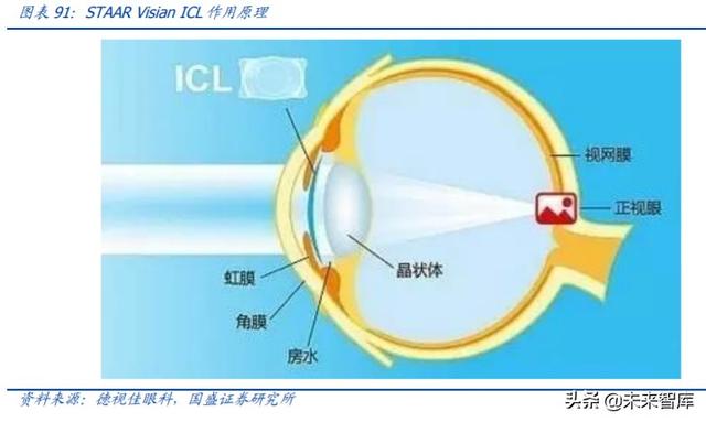 爱博医疗深度解析：专注创新的眼科器械龙头企业