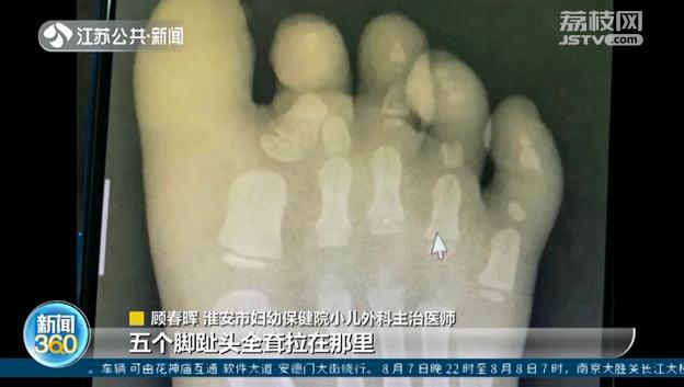 不慎启动压面机 两岁女孩瞬间被&ldquo;咬&rdquo;断5根脚趾