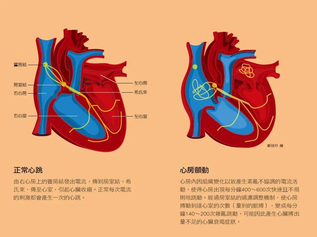 业界「氢弹」来啦！新型口服抗凝药，把房颤“中风”扼杀在摇篮里