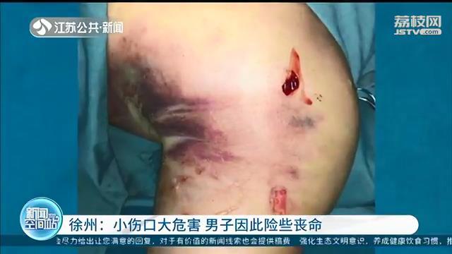 小伤口没往心里去，男子因此险些丧命 输了3000毫升血才救了回来