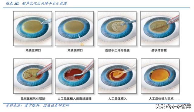 爱博医疗深度解析：专注创新的眼科器械龙头企业