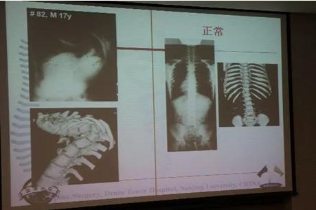 “谢大脚”带着弟弟来谢他，只因19年前那一刀！数百万孩子正在遭受这种痛