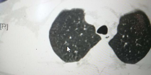 发现肺部结节，能不能吃海鲜？饮食注意什么—肺部结节科普