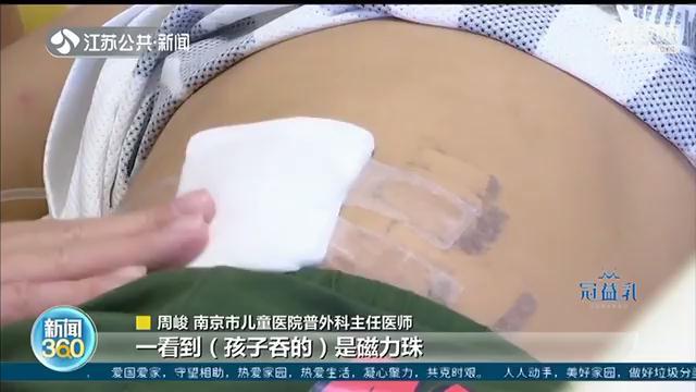 儿童误吞磁力珠进了ICU 医生：肠子吸在一起，几乎排不出来