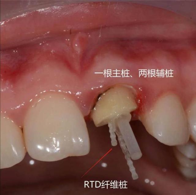 牙齿打桩流程(牙齿打桩做冠流程图片)