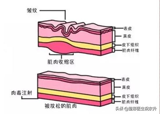 盘点：线雕、肉毒素、玻尿酸、脂肪填充，各抗衰方式的优缺点