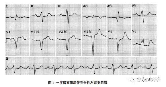 束支阻滞心电图几种特殊现象的分析技巧
