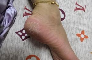 Calcaneal of 38 years old of women is weather-shac