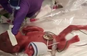 Miracle! The least surviving baby leaves hospital, fruit of the He Ping when be born is about the sa