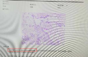 Cancer of spermary of fish of 15 years old of boys