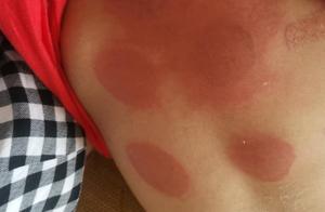 After 92 children stick three fit perfectly by bur