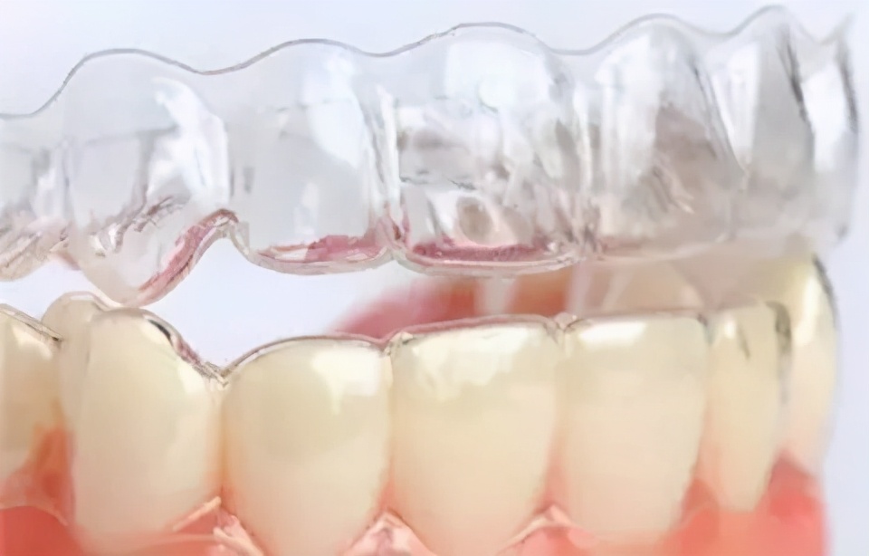 毛利率70%以上，你所不知道的隐形牙套暴利堪比茅台