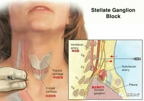 神奇和万能的星状神经节治疗失眠焦虑痛经多汗等