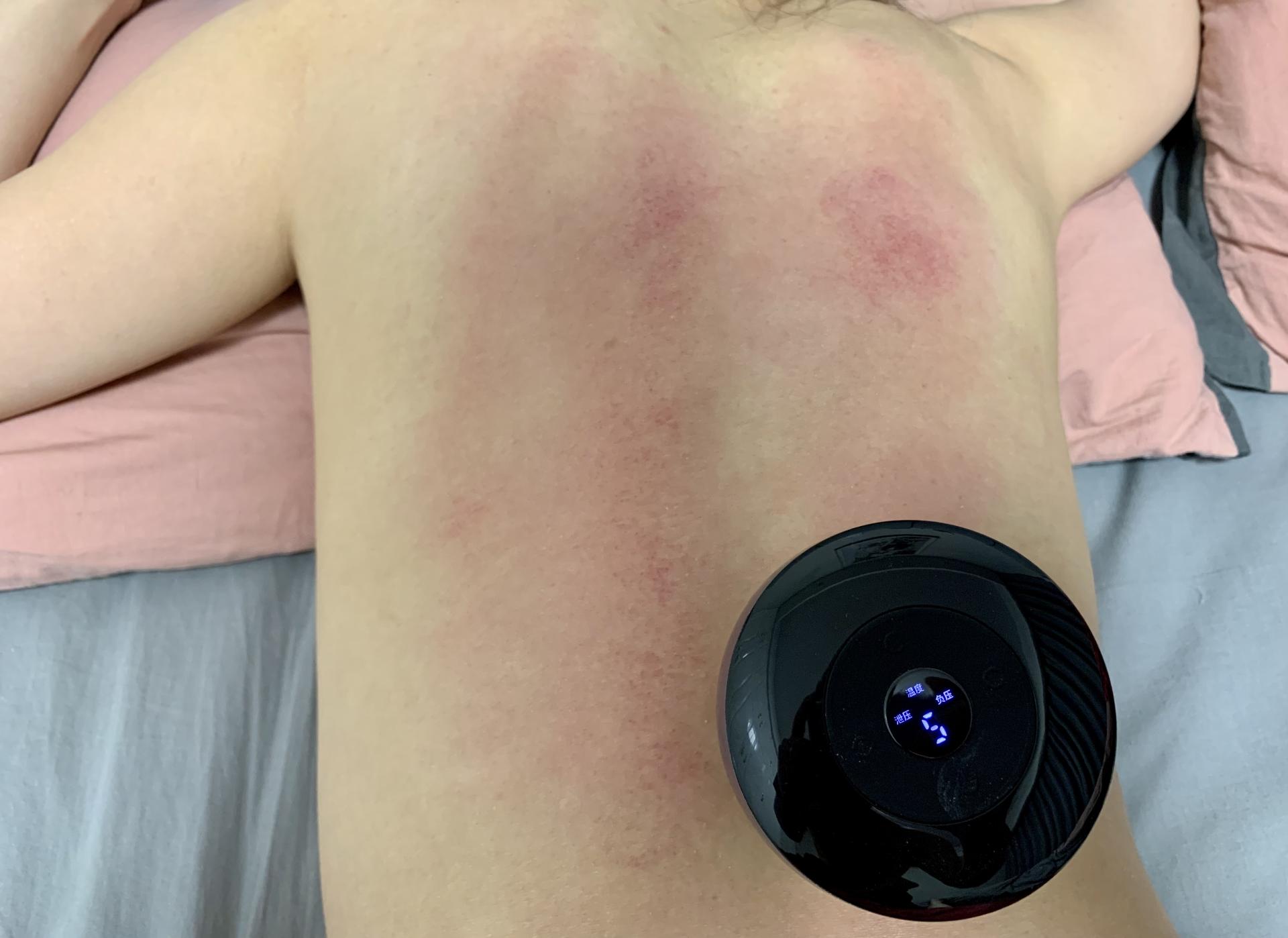走罐智能化是怎样的体验左点智能走罐按摩器上手开启智能养生新时代