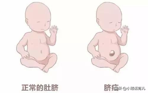 什么是婴儿脐疝如何治疗