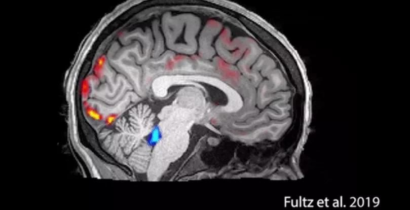 熬夜通宵、嗜糖嗜咸的我们，离阿尔茨海默病有多远？