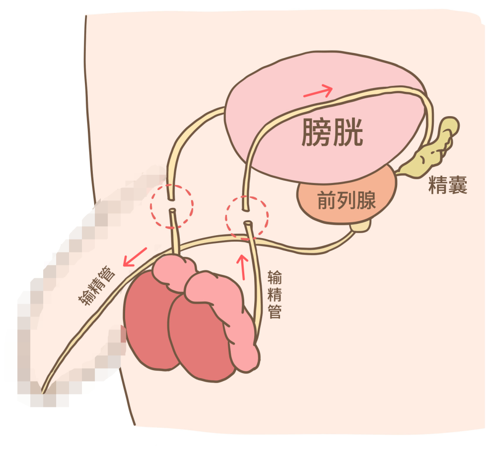 结扎后，精子都去哪了？