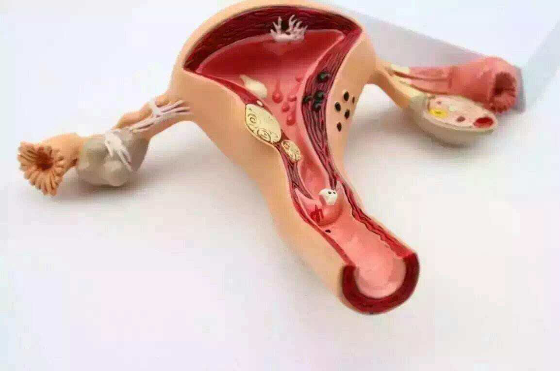 我没怀孕,没流过,为何还得了子宫腺肌症?
