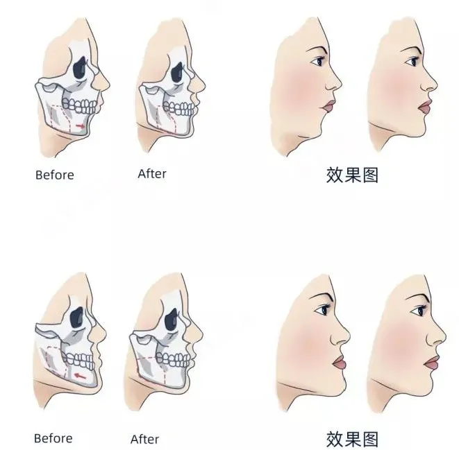 牙齿矫正对于颌骨发育及治疗的影响_牙颌畸形_牙颌