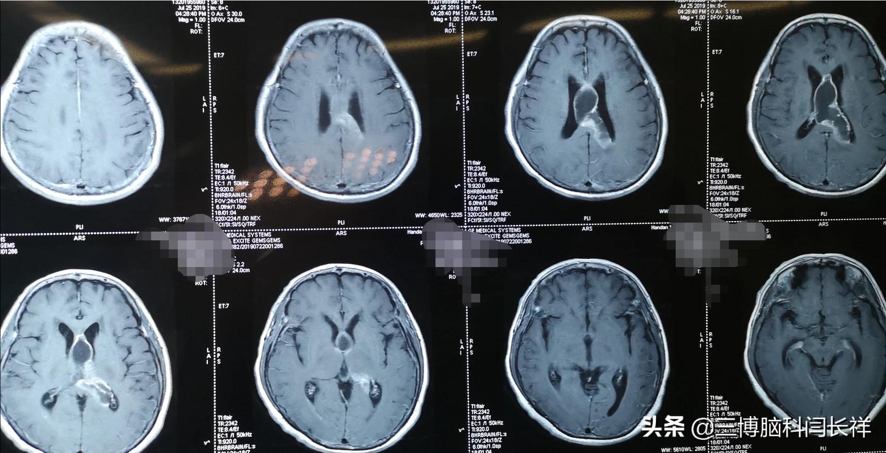 第二台(图5,6,7,8)是昨天的手术,肿瘤堵塞右侧脑室室间孔导致一侧脑