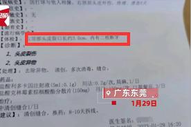 男子打球6天后头皮里发现2颗牙
