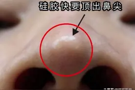 隆鼻失败的概率高吗?想要做鼻子还是先看看这篇文章吧