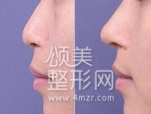 韩式隆鼻手术要多少钱(包茎手术25天恢复图片)