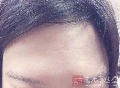 火厄什么意思女人火厄痣是什么意思