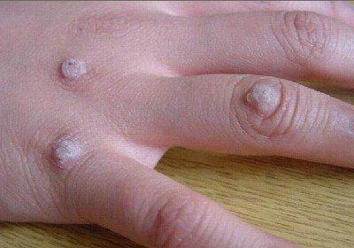 刺瘊子长什么样子图片